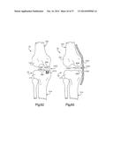 APPARATUS AND METHOD FOR MEASURING FORCES IN A KNEE JOINT diagram and image