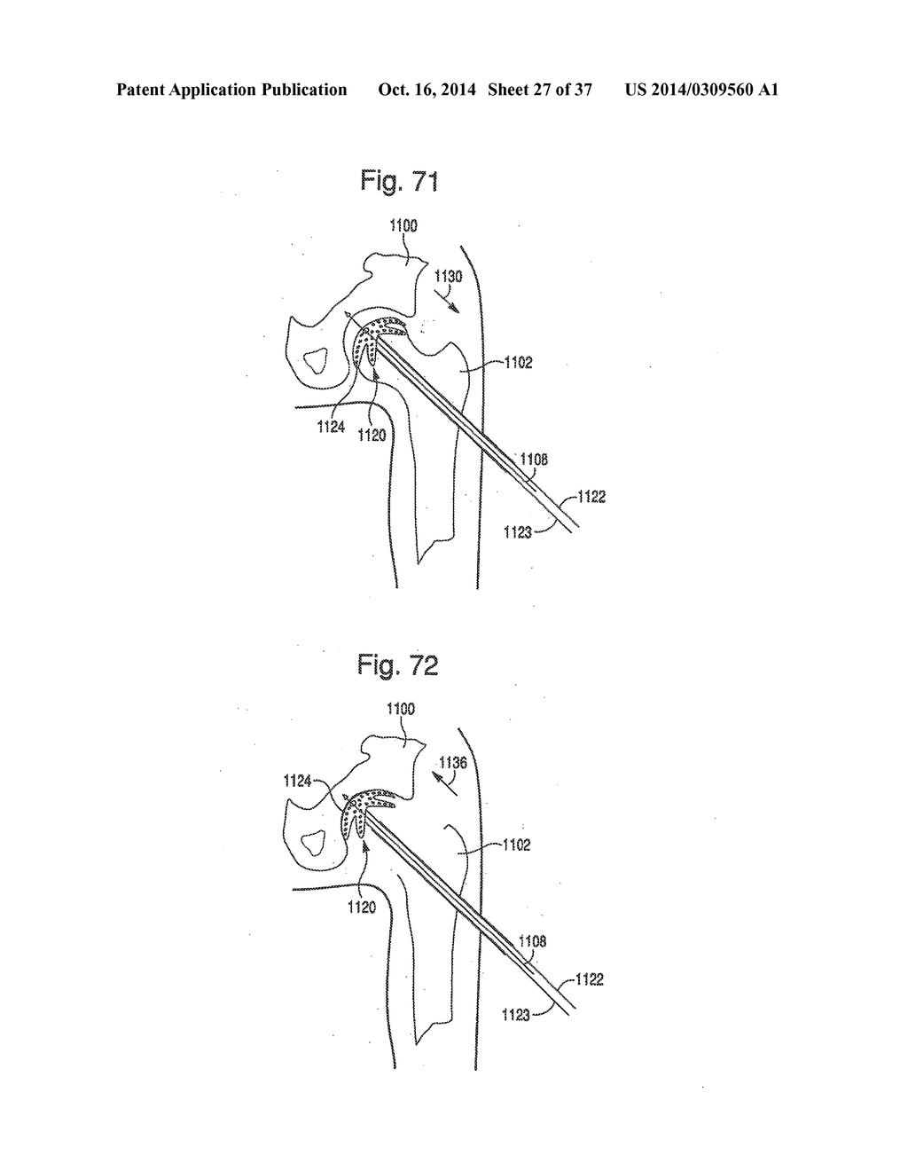 APPARATUS AND METHOD FOR MEASURING FORCES IN A KNEE JOINT - diagram, schematic, and image 28