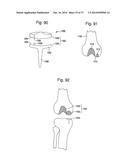 APPARATUS AND METHOD FOR MEASURING FORCES IN A KNEE JOINT diagram and image