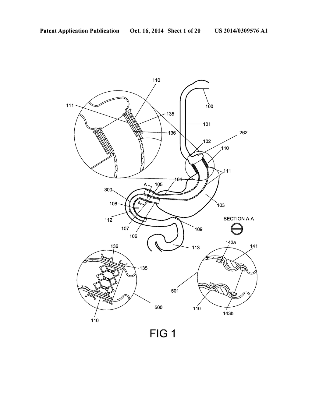 GASTROINTESTINAL PROSTHESES HAVING PARTIAL BYPASS CONFIGURATIONS - diagram, schematic, and image 02