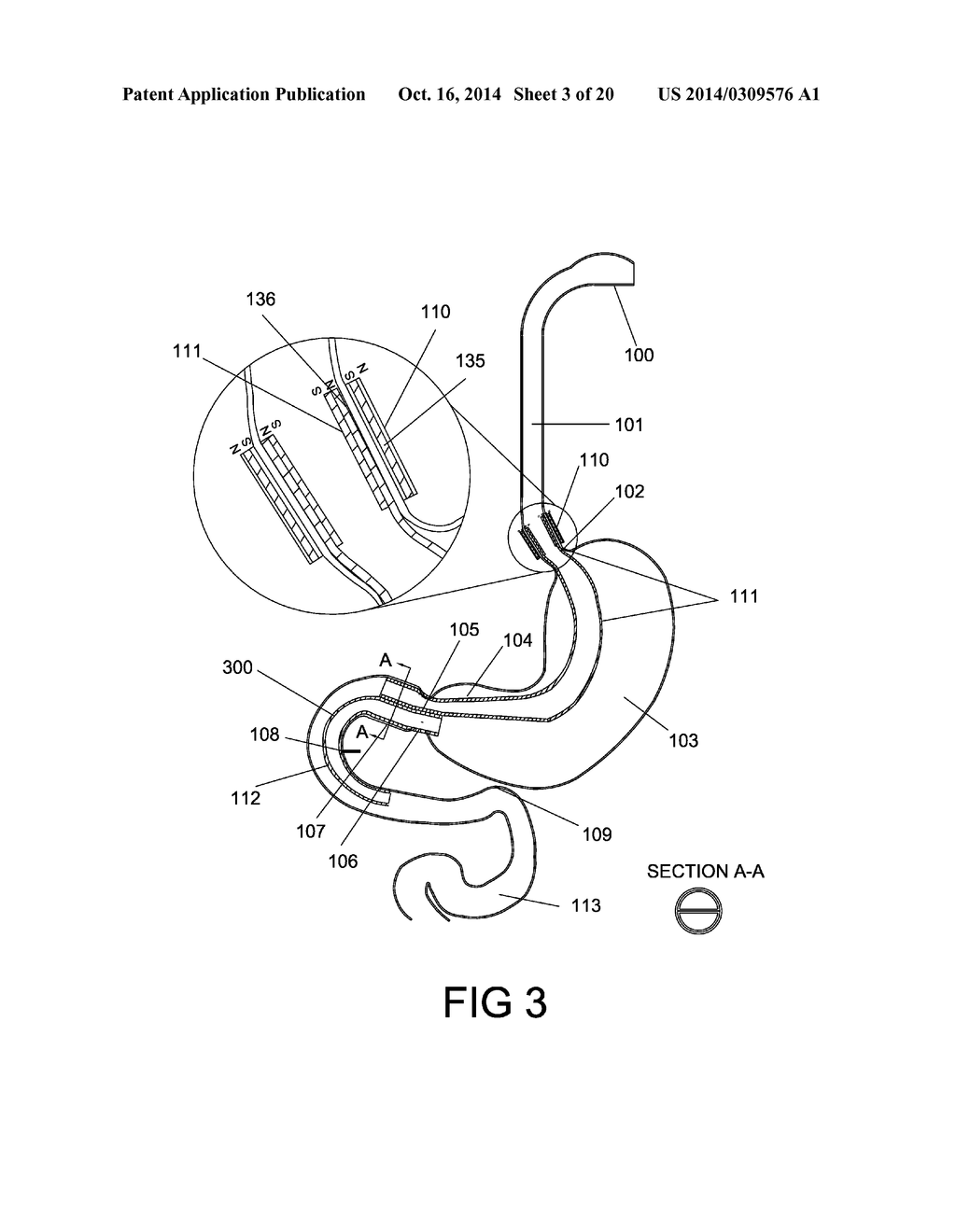 GASTROINTESTINAL PROSTHESES HAVING PARTIAL BYPASS CONFIGURATIONS - diagram, schematic, and image 04