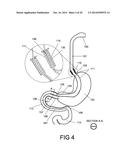 GASTROINTESTINAL PROSTHESES HAVING PARTIAL BYPASS CONFIGURATIONS diagram and image