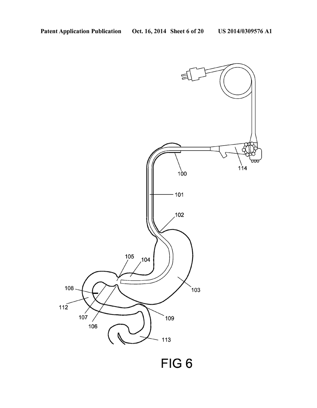 GASTROINTESTINAL PROSTHESES HAVING PARTIAL BYPASS CONFIGURATIONS - diagram, schematic, and image 07