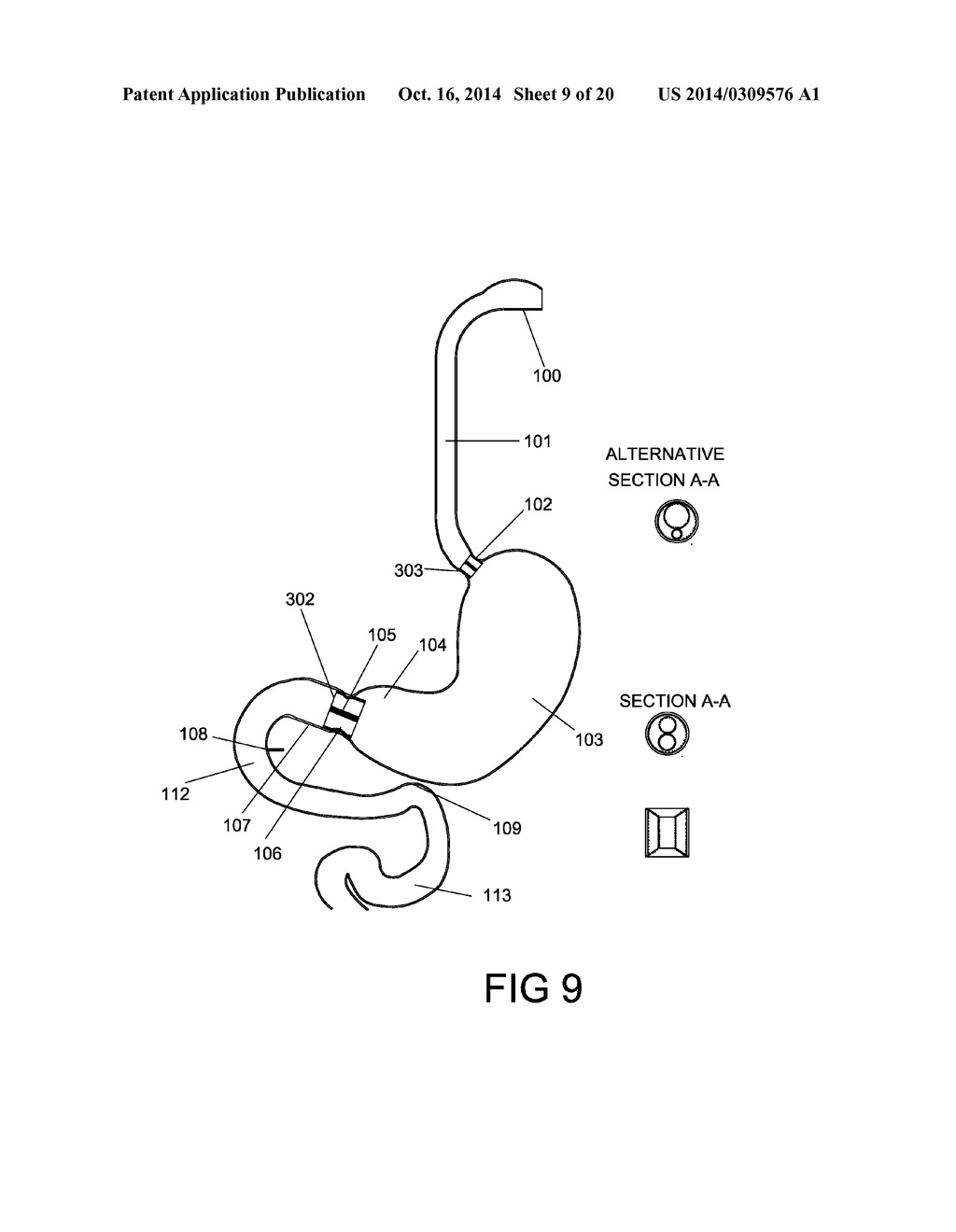 GASTROINTESTINAL PROSTHESES HAVING PARTIAL BYPASS CONFIGURATIONS - diagram, schematic, and image 10