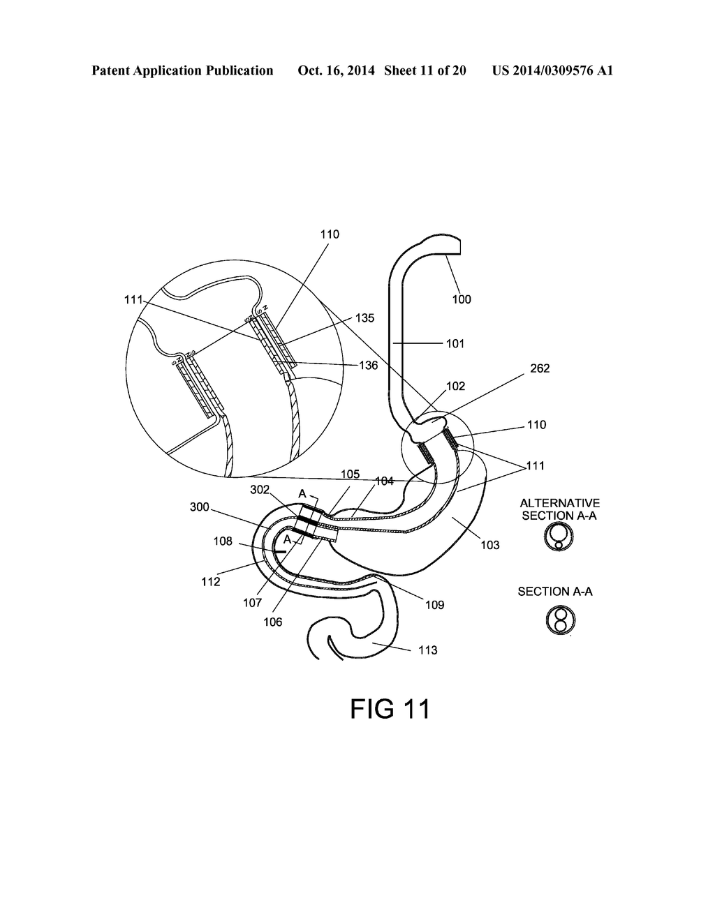 GASTROINTESTINAL PROSTHESES HAVING PARTIAL BYPASS CONFIGURATIONS - diagram, schematic, and image 12