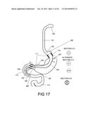 GASTROINTESTINAL PROSTHESES HAVING PARTIAL BYPASS CONFIGURATIONS diagram and image