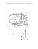 SLEEVES, MANIFOLDS, SYSTEMS, AND METHODS FOR APPLYING REDUCED PRESSURE TO     A SUBCUTANEOUS TISSUE SITE diagram and image