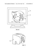 Patient-Specific-Bone-Cutting Guidance Instruments And Methods diagram and image