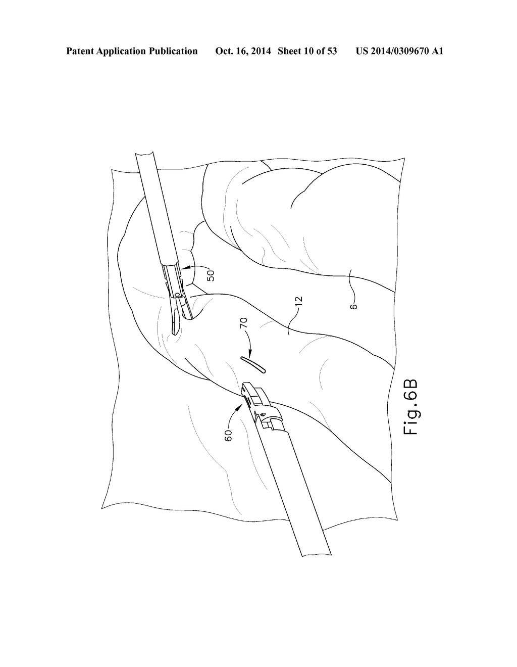 METHOD AND APPARATUS FOR JOINING HOLLOW ORGAN SECTIONS IN ANASTOMOSIS - diagram, schematic, and image 11