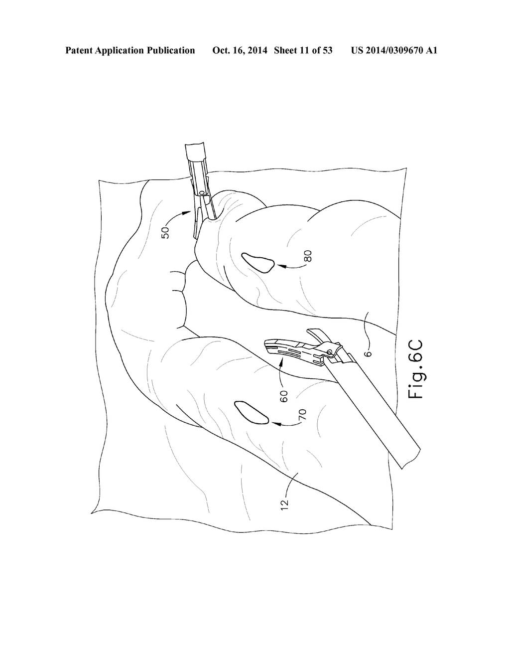 METHOD AND APPARATUS FOR JOINING HOLLOW ORGAN SECTIONS IN ANASTOMOSIS - diagram, schematic, and image 12