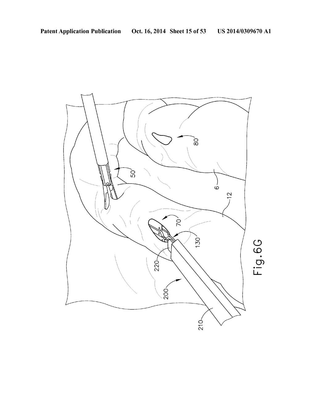 METHOD AND APPARATUS FOR JOINING HOLLOW ORGAN SECTIONS IN ANASTOMOSIS - diagram, schematic, and image 16