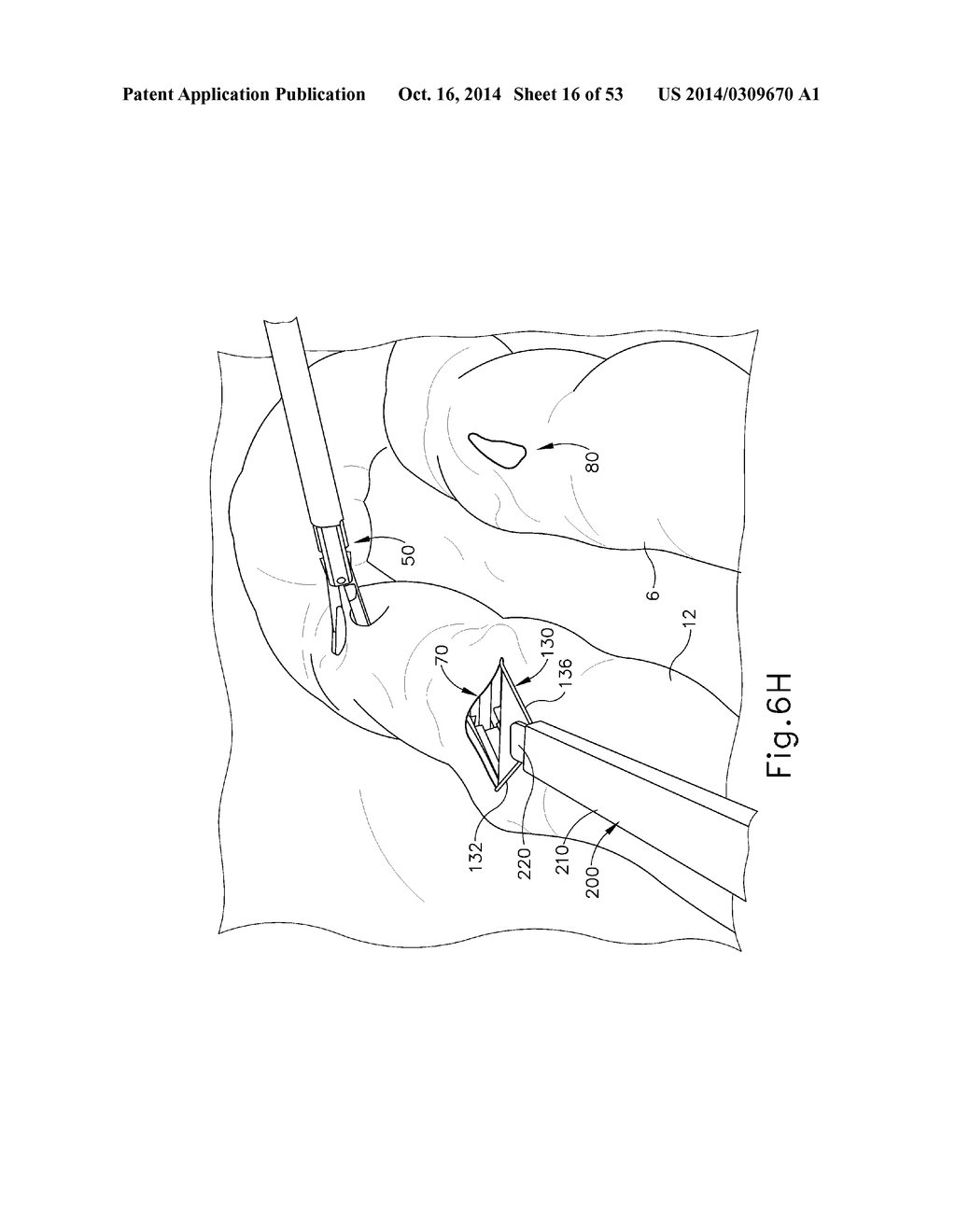 METHOD AND APPARATUS FOR JOINING HOLLOW ORGAN SECTIONS IN ANASTOMOSIS - diagram, schematic, and image 17