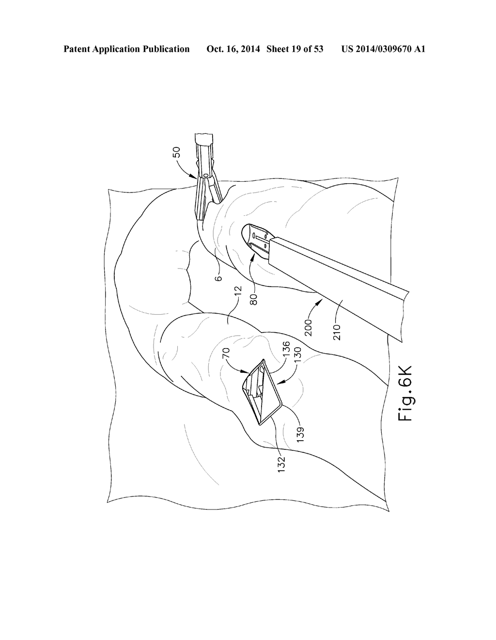 METHOD AND APPARATUS FOR JOINING HOLLOW ORGAN SECTIONS IN ANASTOMOSIS - diagram, schematic, and image 20