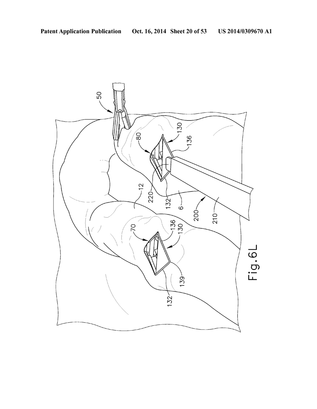 METHOD AND APPARATUS FOR JOINING HOLLOW ORGAN SECTIONS IN ANASTOMOSIS - diagram, schematic, and image 21