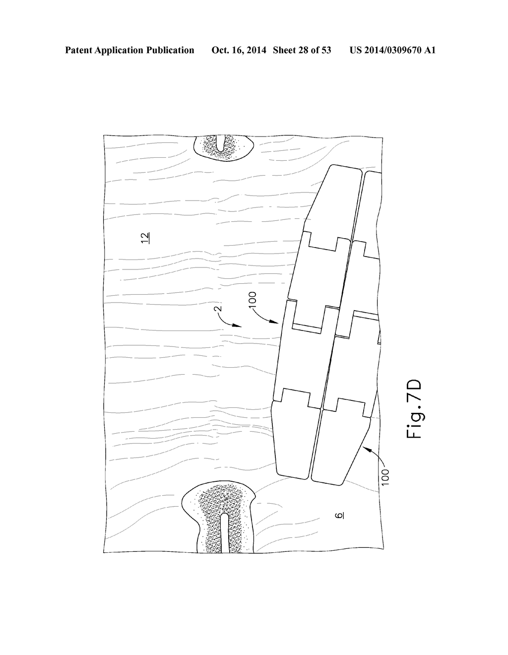 METHOD AND APPARATUS FOR JOINING HOLLOW ORGAN SECTIONS IN ANASTOMOSIS - diagram, schematic, and image 29