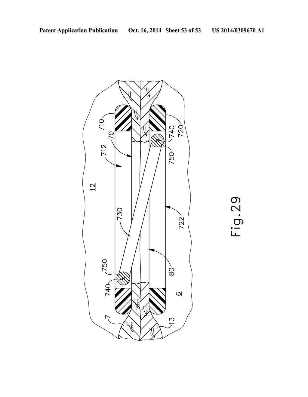 METHOD AND APPARATUS FOR JOINING HOLLOW ORGAN SECTIONS IN ANASTOMOSIS - diagram, schematic, and image 54