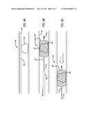 DEVICES FOR REMOVING VESSEL OCCLUSIONS diagram and image