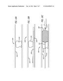 DEVICES FOR REMOVING VESSEL OCCLUSIONS diagram and image