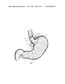 BARIATRIC DEVICE AND METHOD diagram and image