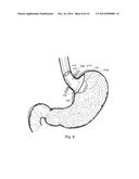 BARIATRIC DEVICE AND METHOD diagram and image