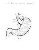 BARIATRIC DEVICE AND METHOD diagram and image