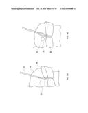 KNOTLESS FILAMENT ANCHOR FOR SOFT TISSUE REPAIR diagram and image