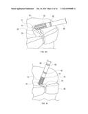 KNOTLESS FILAMENT ANCHOR FOR SOFT TISSUE REPAIR diagram and image