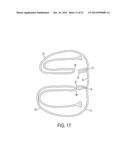 Suture System and Method diagram and image