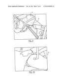 PELVIC CABLE SOLUTION diagram and image