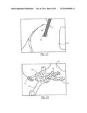 PELVIC CABLE SOLUTION diagram and image