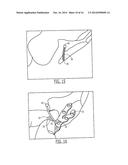 PELVIC CABLE SOLUTION diagram and image