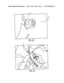 PELVIC CABLE SOLUTION diagram and image