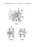 TELESCOPING INTERSPINOUS FIXATION DEVICE AND METHODS OF USE diagram and image