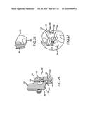 TELESCOPING INTERSPINOUS FIXATION DEVICE AND METHODS OF USE diagram and image