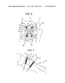 BENDING TOOL AND METHOD FOR RESHAPING A BONE PLATE diagram and image