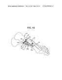 BENDING TOOL AND METHOD FOR RESHAPING A BONE PLATE diagram and image