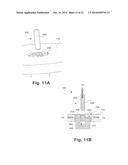 CERVICAL POP RIVET LOCKING MECHANISM diagram and image