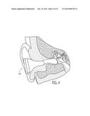 DEVICES AND METHODS FOR VESTIBULAR AND/OR CRANIAL NERVE STIMULATION diagram and image