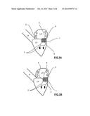 MITRAL HEART VALVE PROSTHESIS AND ASSOCIATED DELIVERY CATHETER diagram and image