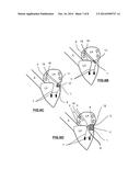 MITRAL HEART VALVE PROSTHESIS AND ASSOCIATED DELIVERY CATHETER diagram and image