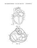 Devices and Methods for Treating Valvular Regurgitation diagram and image