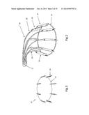 Heart Valve Repair Device diagram and image