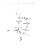 Heart Valve Repair Device diagram and image