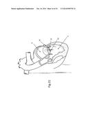 Heart Valve Repair Device diagram and image