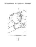 Heart Valve Repair Device diagram and image