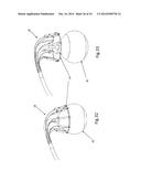 Heart Valve Repair Device diagram and image