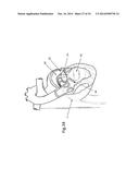 Heart Valve Repair Device diagram and image