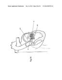 Heart Valve Repair Device diagram and image