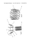 Heart Valve Repair Device diagram and image