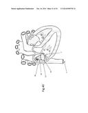 Heart Valve Repair Device diagram and image